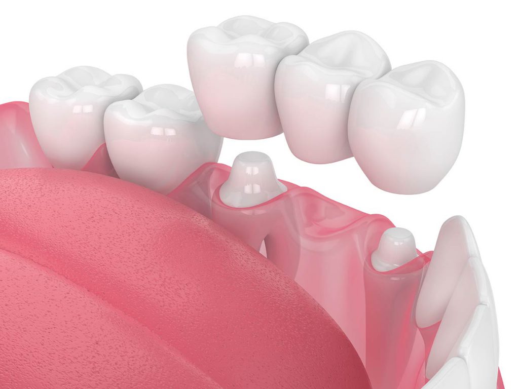 Dental Bridges Noble Smiles Dentistry, Noblesville IN