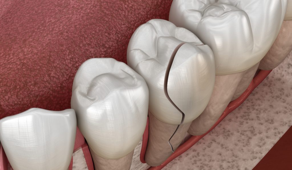 Cracked tooth