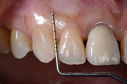 Risk factors for periodontal disease